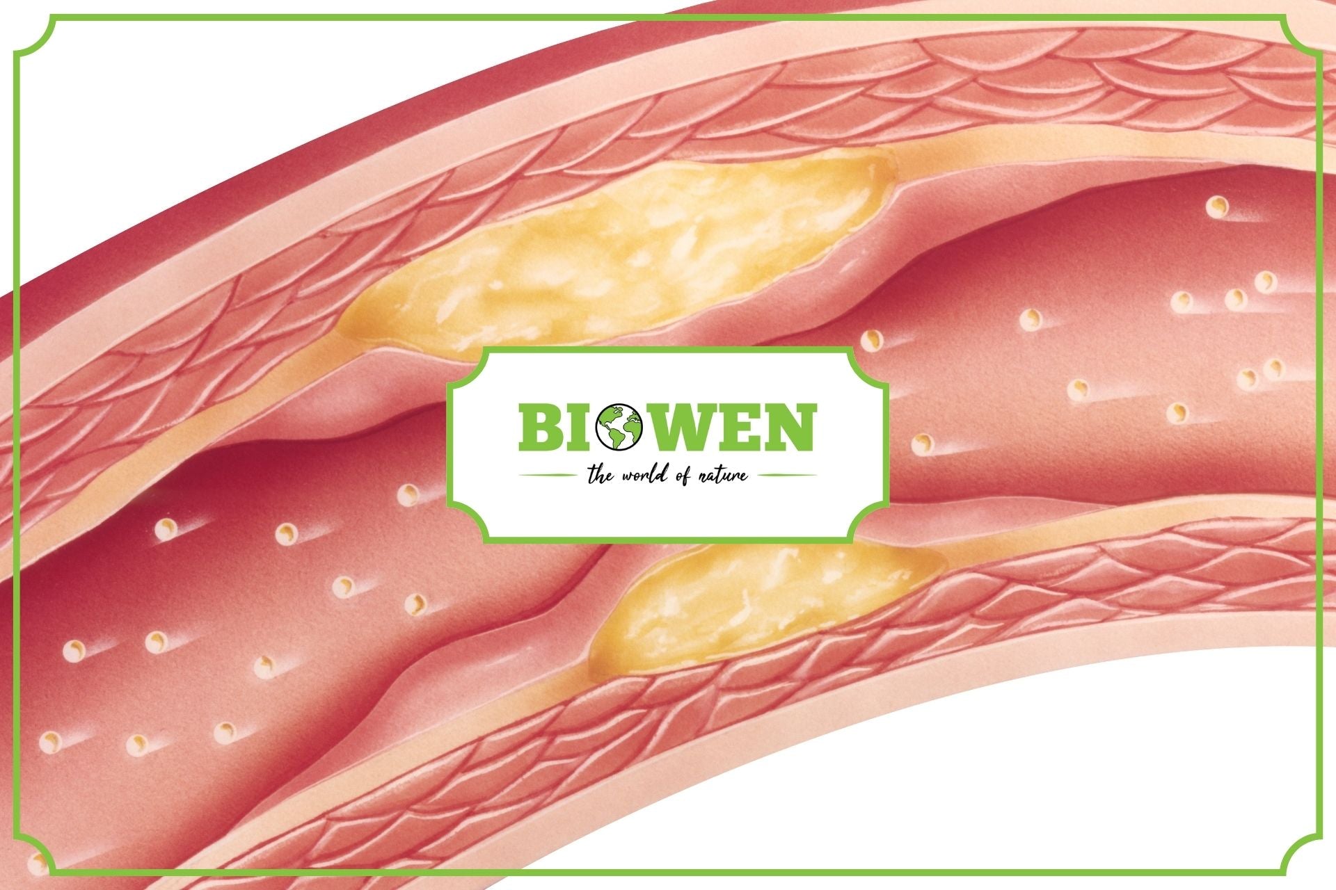 Miażdżyca – przyczyny, profilaktyka i leczenie