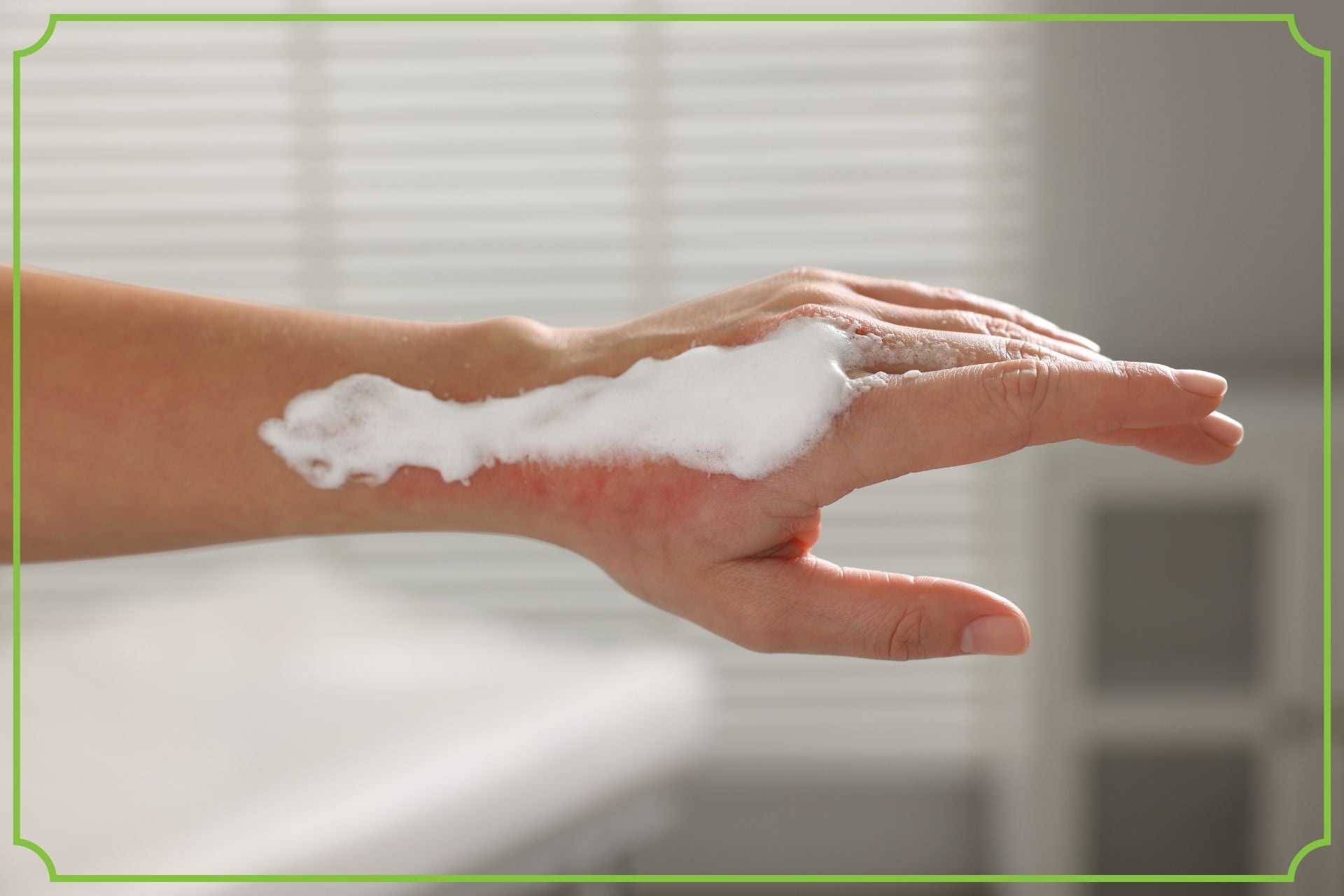 Oparzenia i odmrożenia – charakterystyka, pierwsza pomoc i profilaktyka