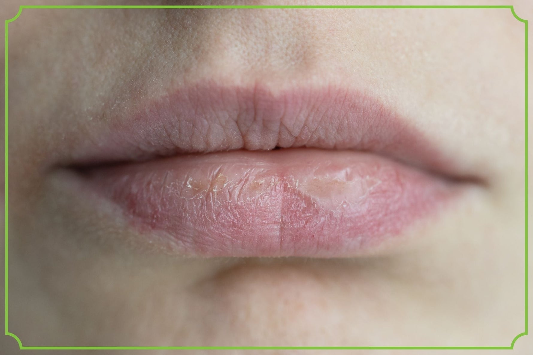 Suche usta – jak je nawilżyć i przywrócić gładkość? Przyczyny, pielęgnacja i domowe sposoby