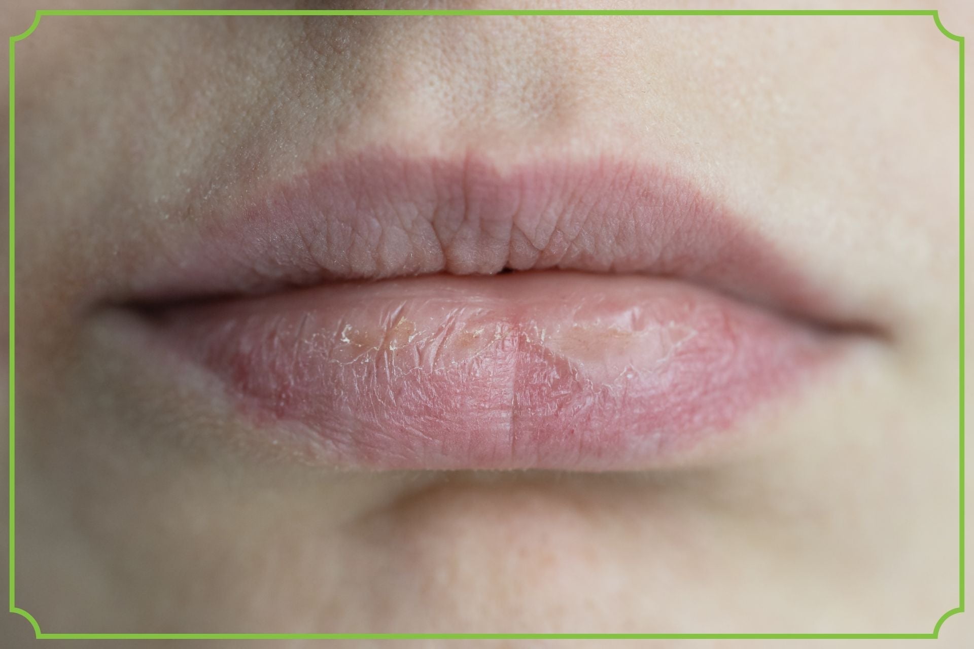 Suche usta – jak je nawilżyć i przywrócić gładkość? Przyczyny, pielęgnacja i domowe sposoby