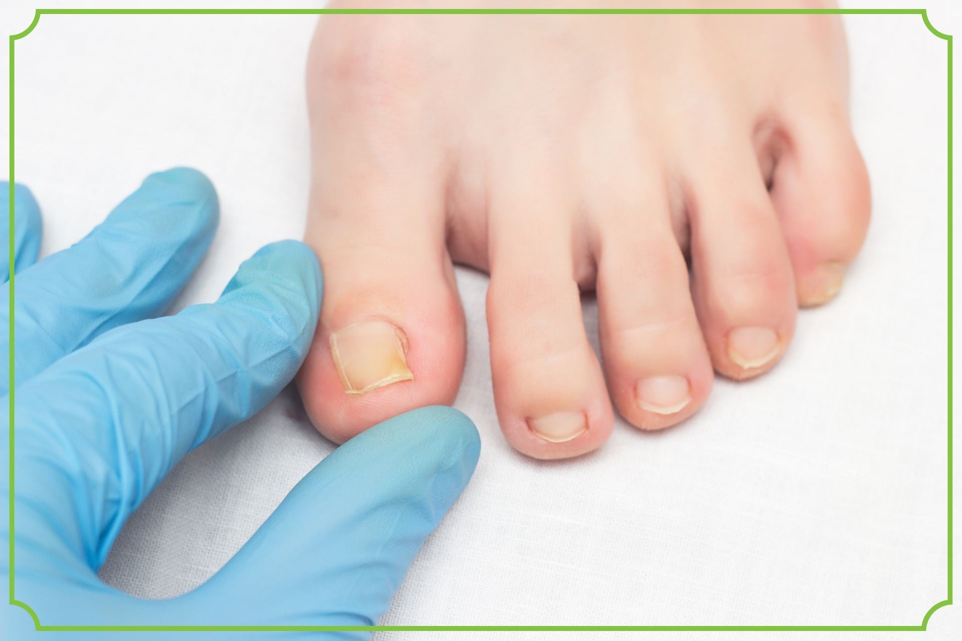 Grzybica paznokci i stóp – jak je rozpoznać i leczyć?