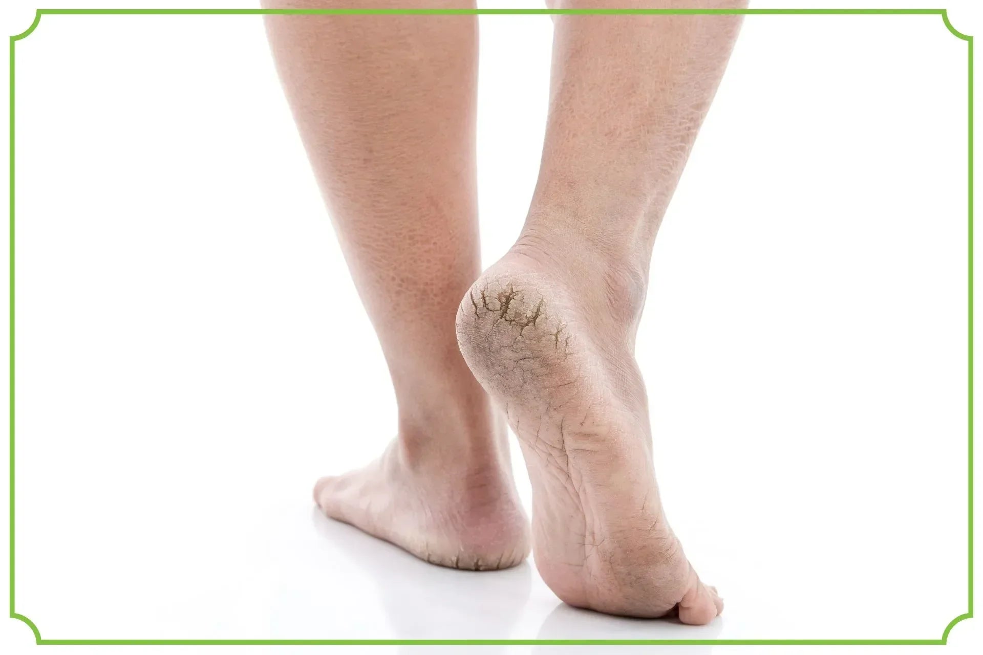 Pękające pięty – co oznaczają i jak sobie z nimi radzić - obrazek wyróżniający