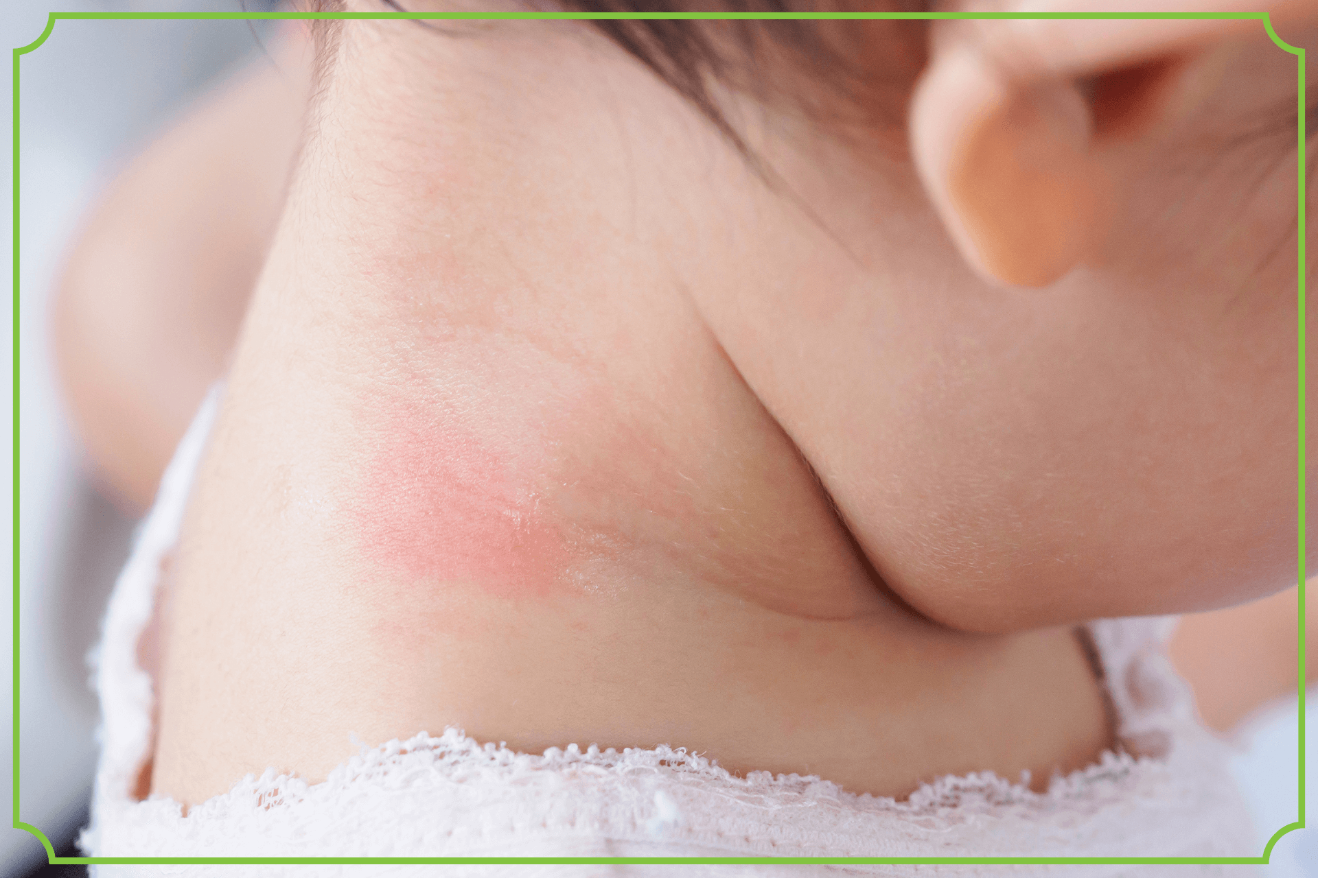 Pokrzywka u dzieci – objawy, przyczyny, leczenie