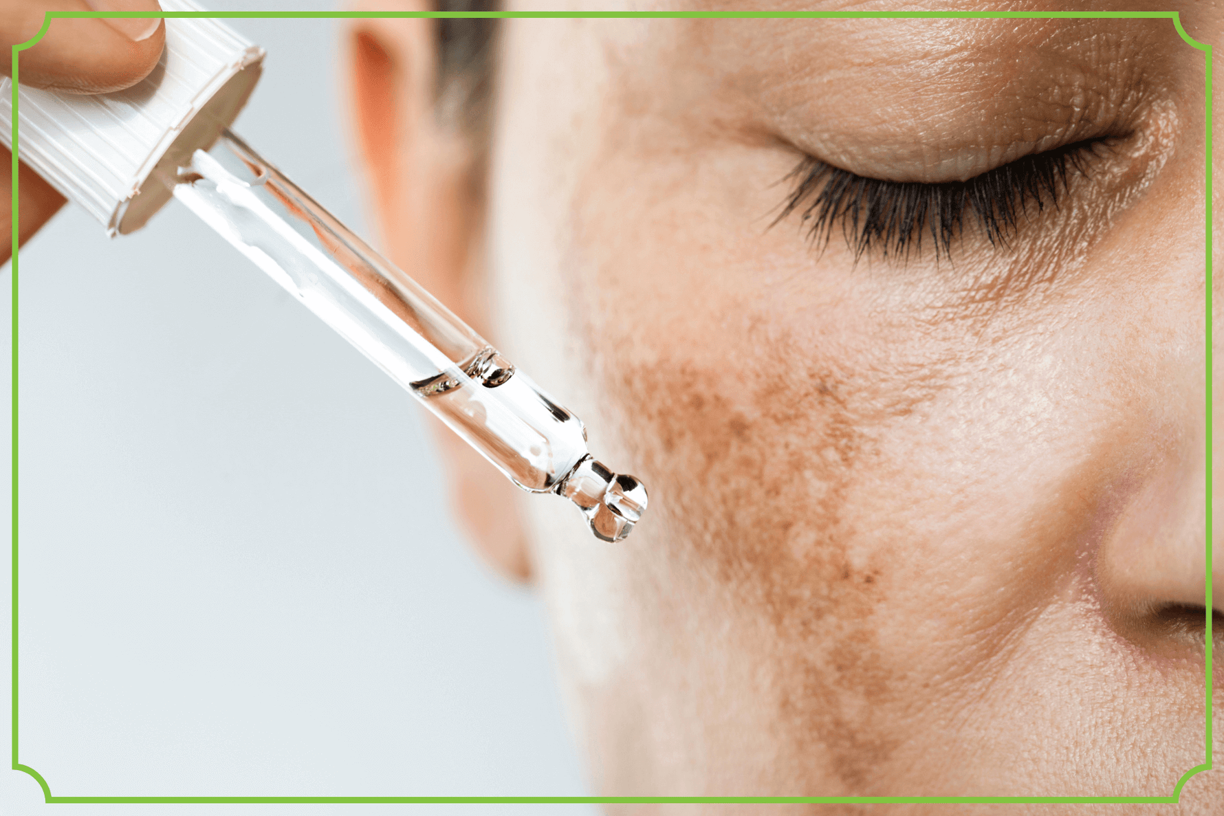 Przebarwienia skóry - obrazek wyróżniający