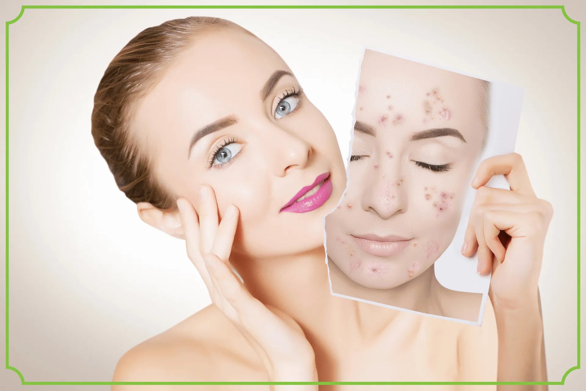 Trądzik pod kontrolą doceń rolę odpowiedniej pielęgnacji - obrazek wyróżniający