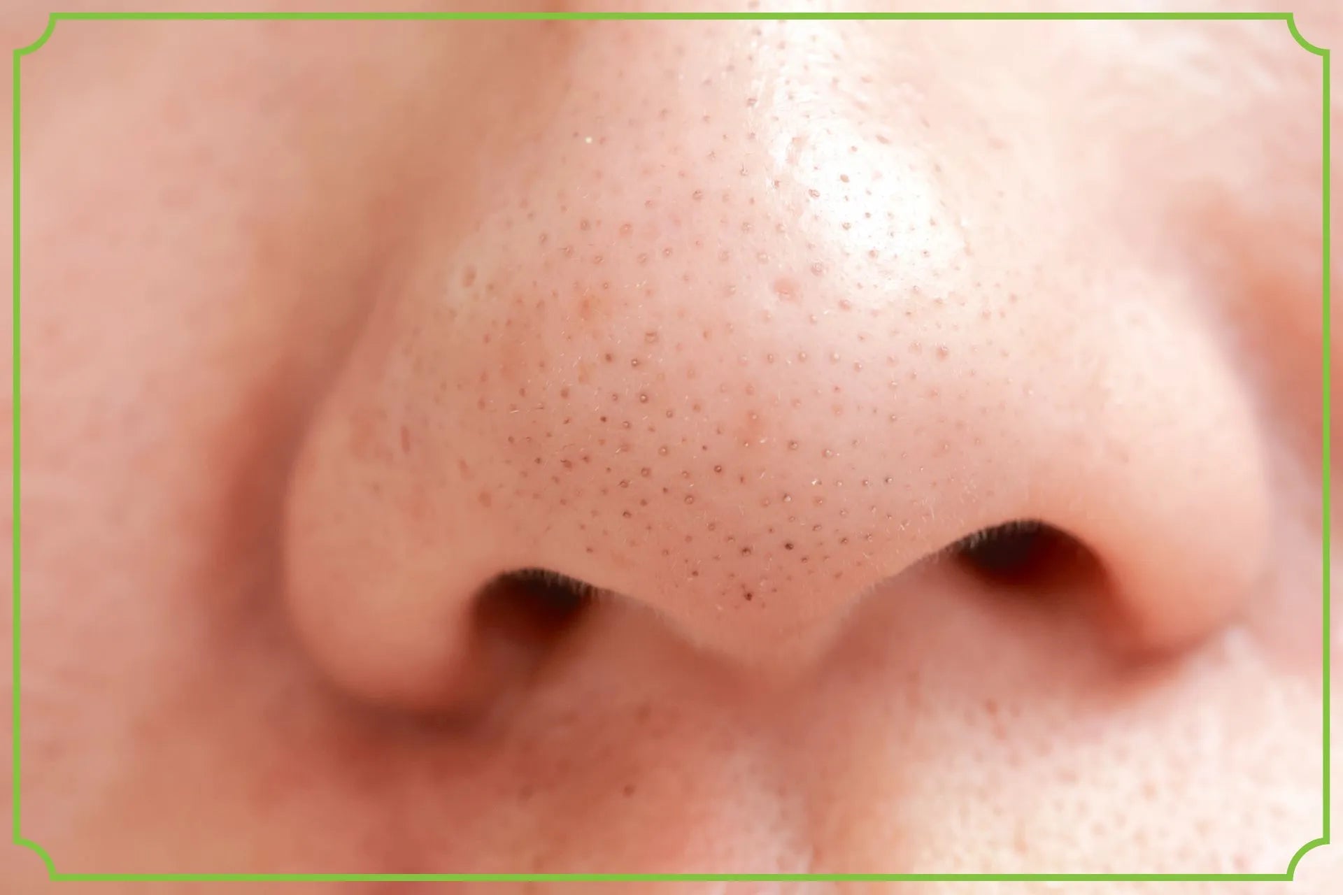 Zaskórniki – czym są, dlaczego powstają i jak się ich skutecznie pozbyć? - obrazek wyróżniający