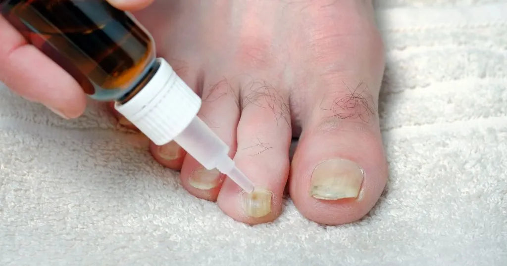 Grzybica paznokci - zdjęcie poglądowe