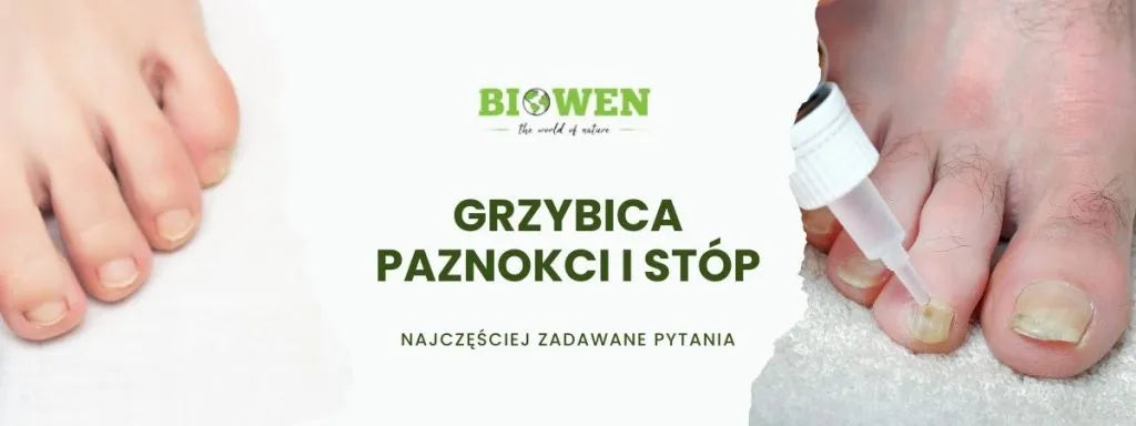 Grzybica paznokci i stóp FAQ - obrazek poglądowy