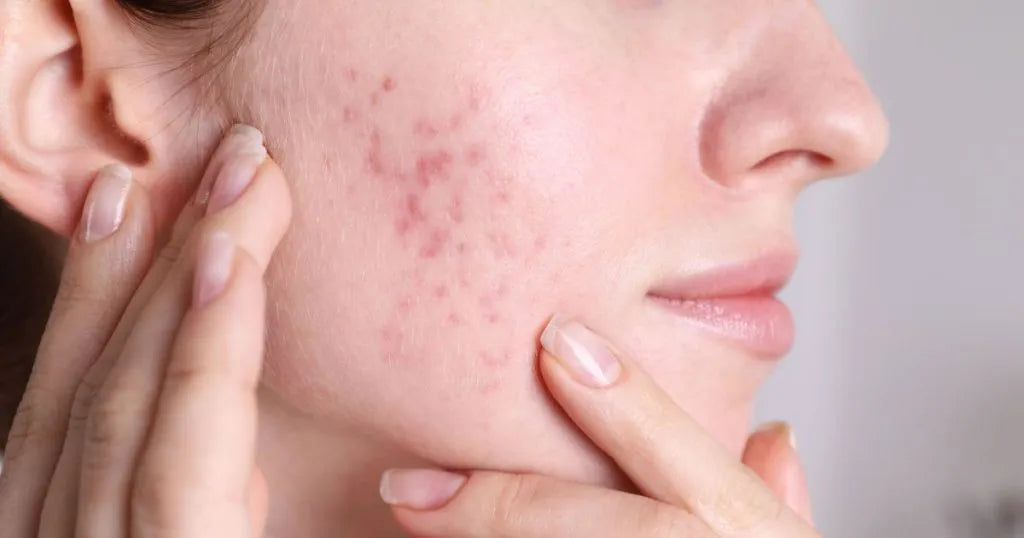 Jak wygląda trądzik - zdjęcie poglądowe