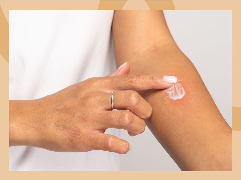 Nakładanie kremu na podrażnioną skórę przedramienia – pielęgnacja przy potówkach.