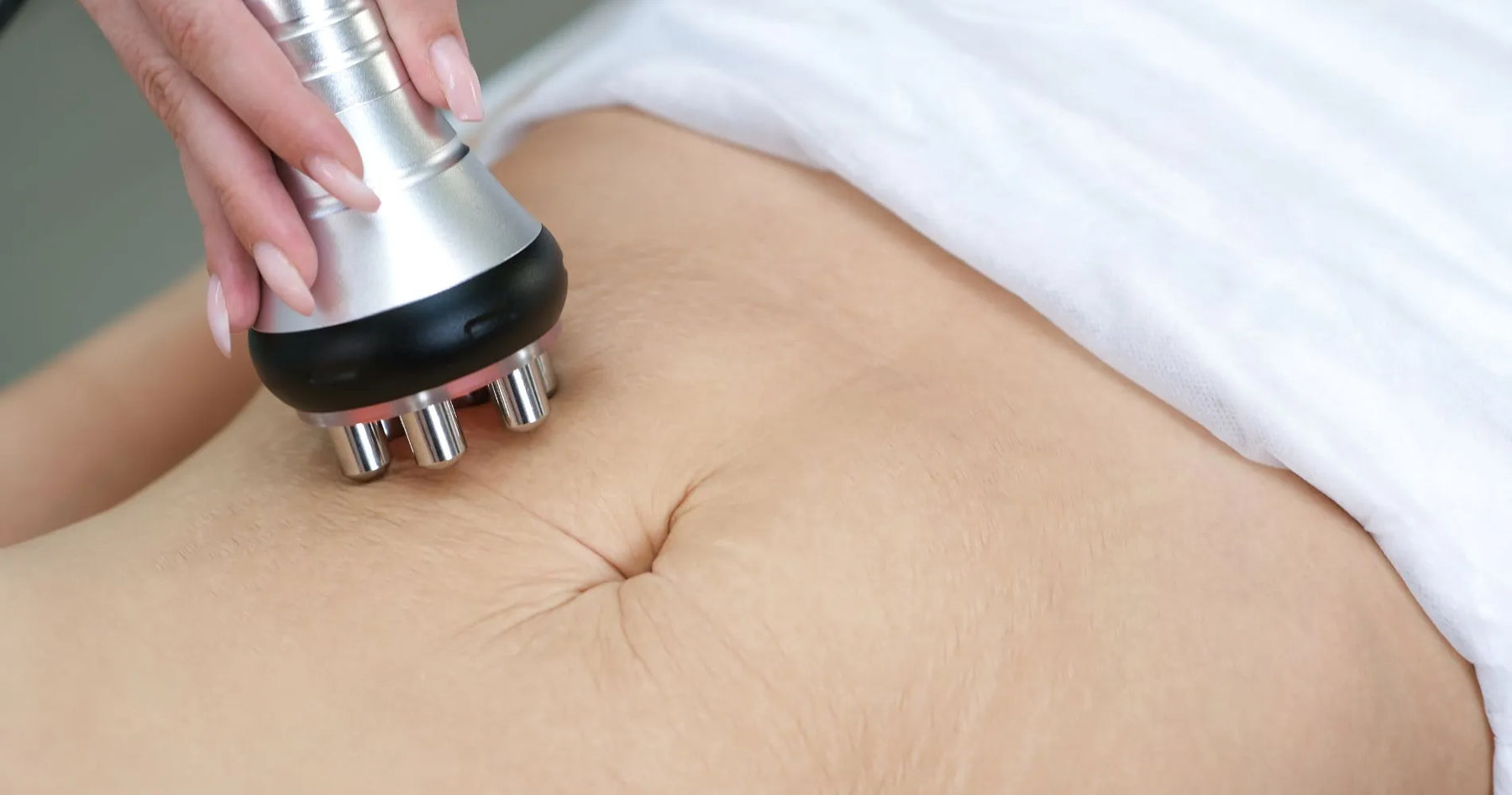 Zabieg redukcji rozstępów na brzuchu za pomocą urządzenia kosmetycznego.