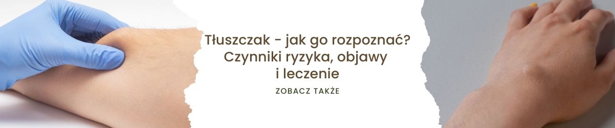 Tłuszczak - jak go rozpoznać - zobacz także