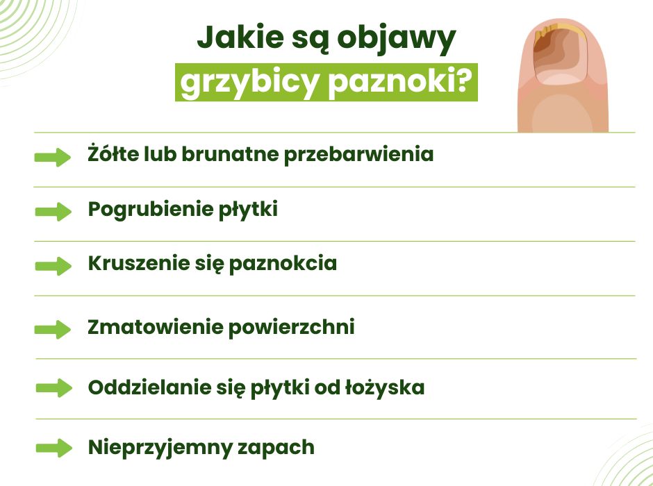 Objawy grzybicy paznokci - infografika
