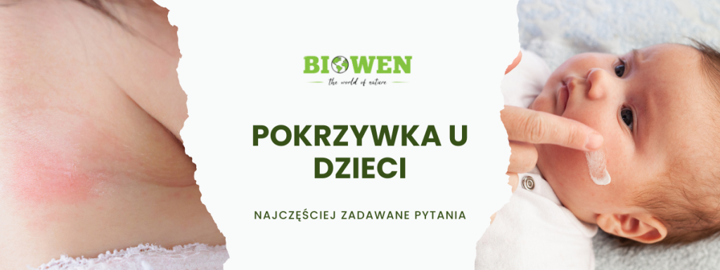 Pokrzywka u dzieci FAQ - obrazek poglądowy