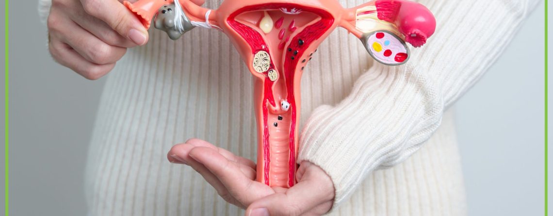 Endometrioza-objawy, przyczyny i leczenie - obrazek wyróżniający