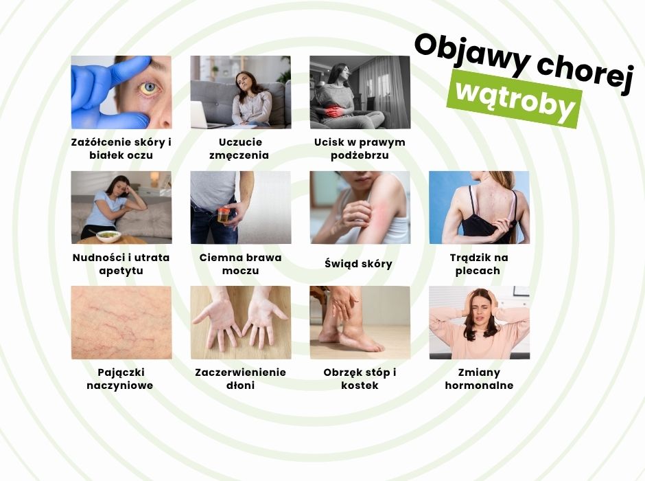 objawy chorej wątroby typowe i nietypowe