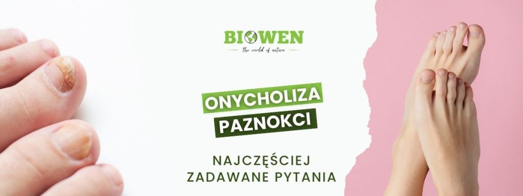 Onycholiza paznokci FAQ - obrazek poglądowy