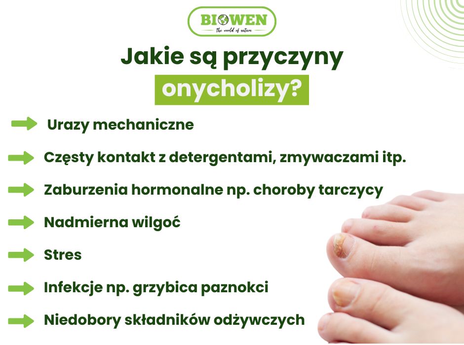 Przyczyny onycholizy - infografika